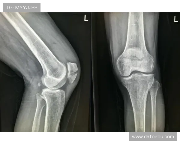 法比安左膝髌骨裂未愈暂不出战